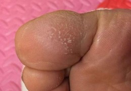 脚刺图片高清展示 了解脚底长刺的具体症状表现