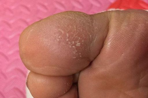 脚刺图片高清展示 了解脚底长刺的具体症状表现