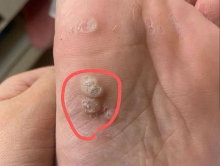 脚刺图片高清展示 了解脚底长刺的具体症状表现